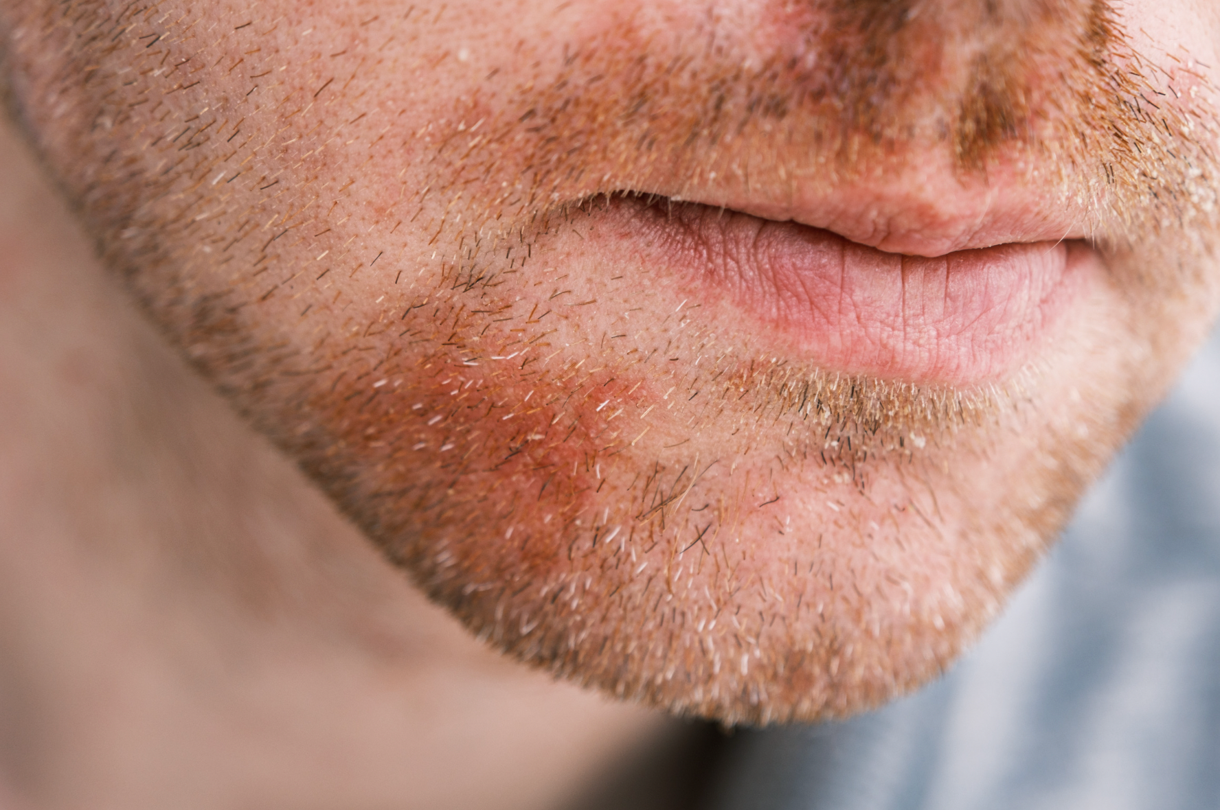 Best Products For Perioral Dermatitis