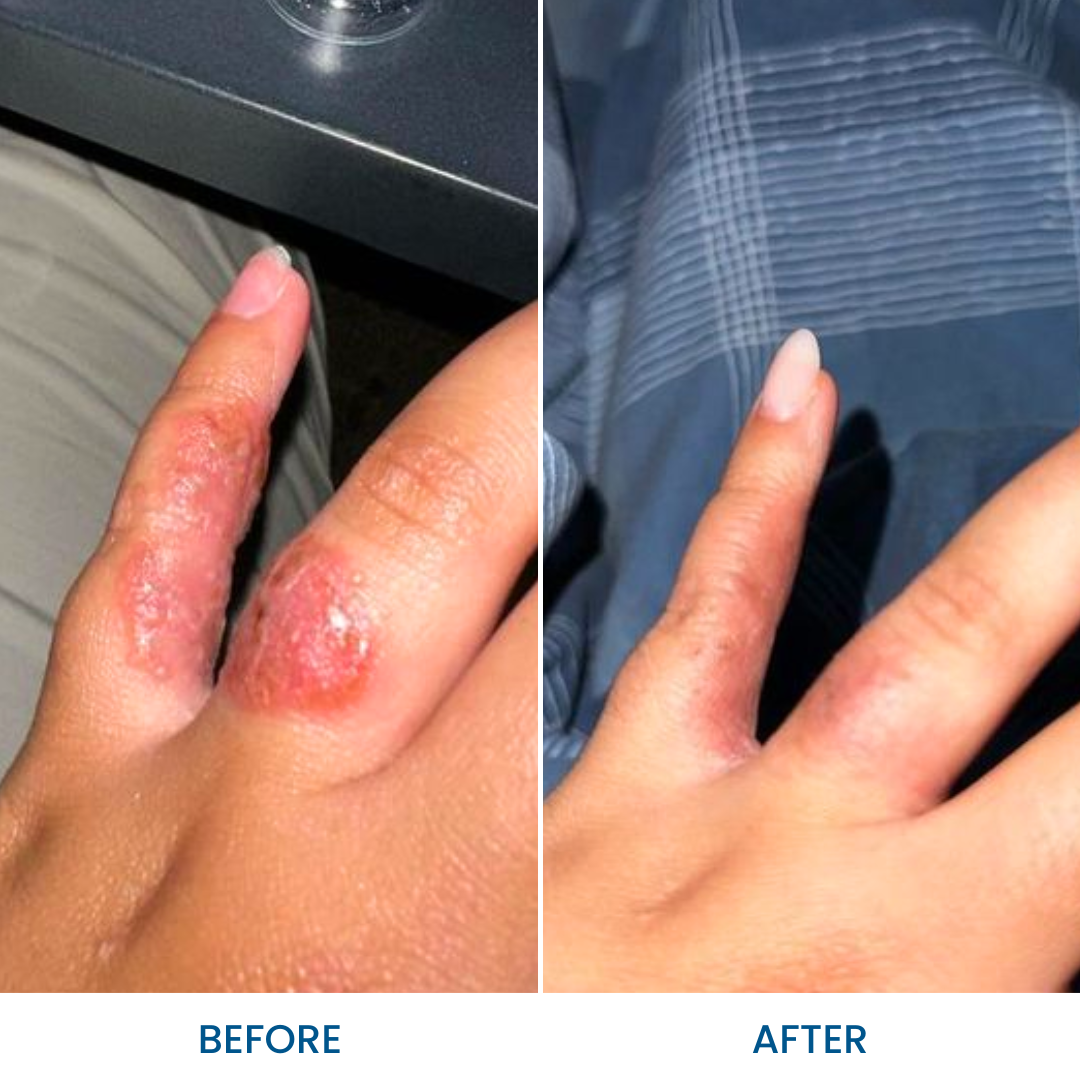 Eczema Gel