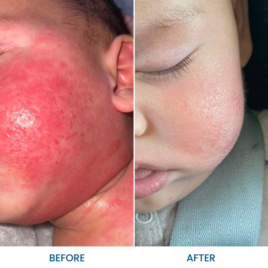 Baby Eczema Pack