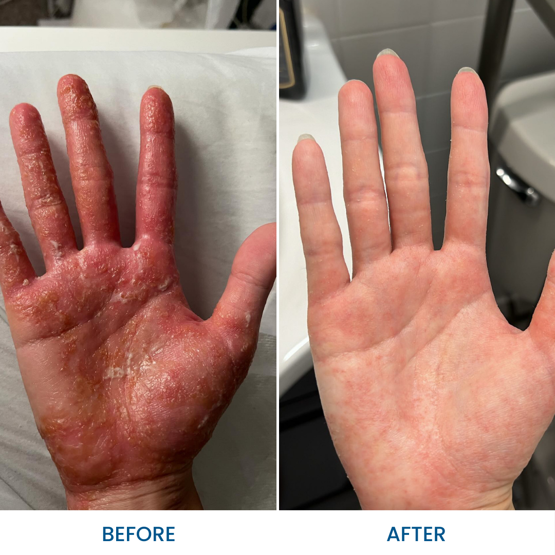 Eczema Trial Pack