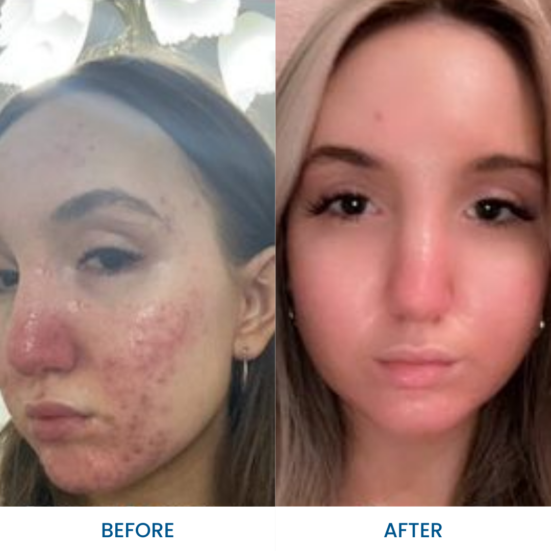 Acne Rosacea Cream