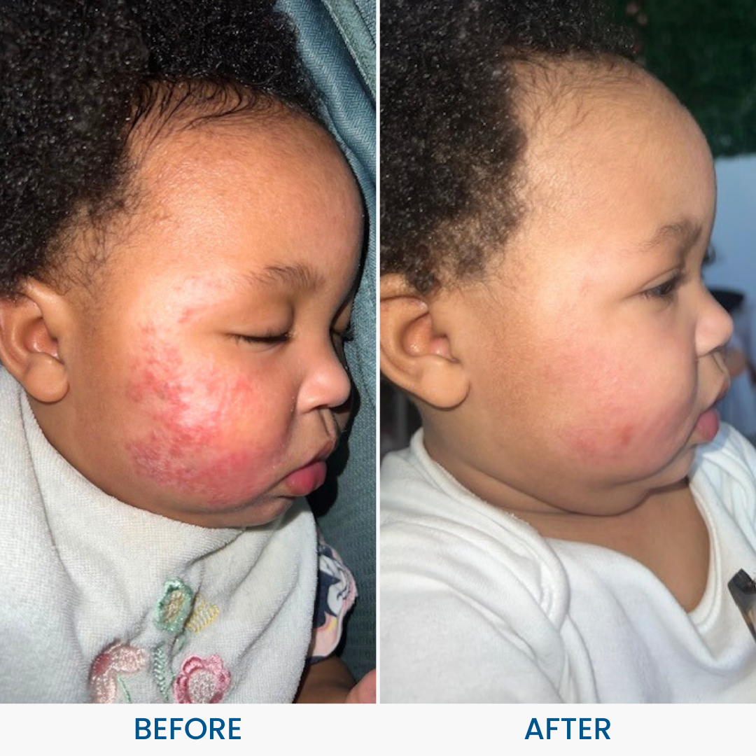 Baby Eczema Cream