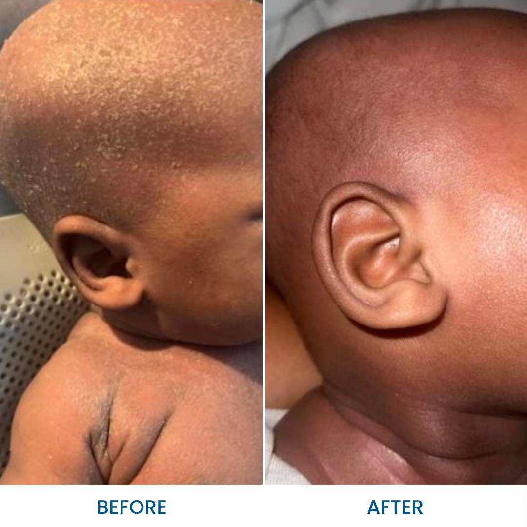 Oil for cradle cap