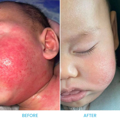 eczema face baby